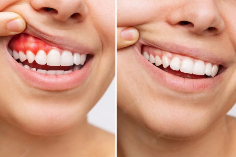 Gum Disease treatment - yashomati Dental Clinic Implant Center