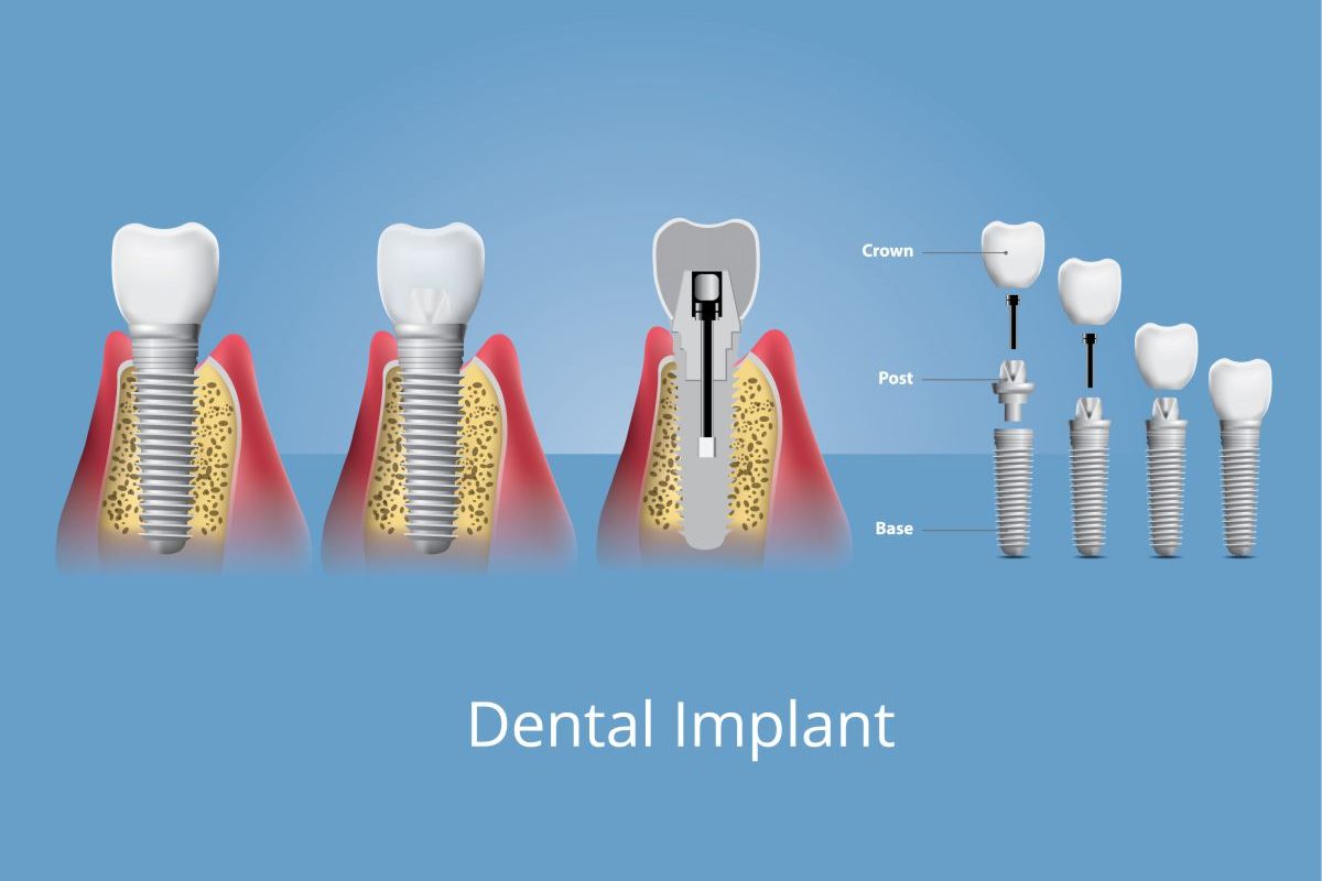 Dental-Implant-Yashomati-Dental-Clinic-Implant-Center